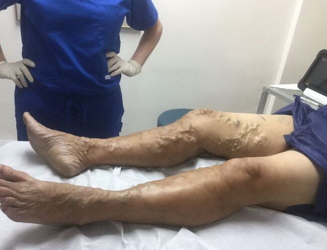 πώς να αναγνωρίσετε ένα σημάδι κιρσών φλεβών