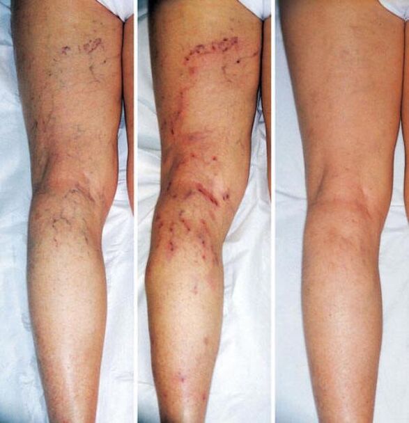 στάδια κιρσών των κάτω άκρων